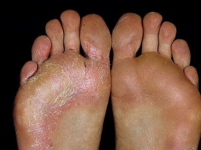 Symptome eines Fußpilzes