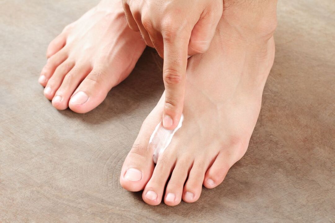 Fußpilz mit Salbe behandeln