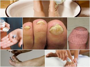 Fuß-Pilz-Behandlung
