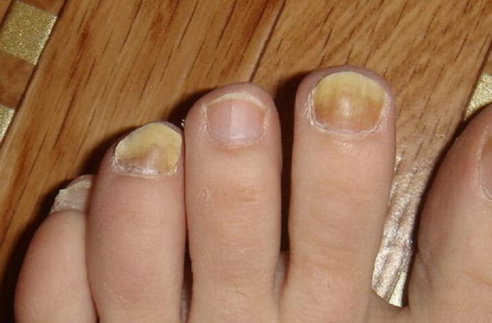 Symptome von Pilzen auf den Nägeln und der Haut der Füße