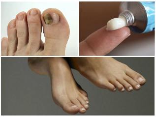 Pilzbefall der Fußnägel, Behandlung