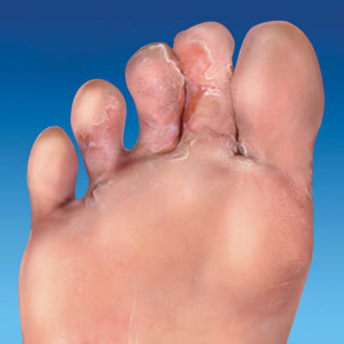 Haut-Pilz-Füße