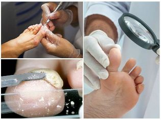 Pilz-Fuß-Haut-Diagnose