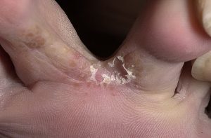Formen der Fuß-Pilz